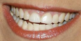 Katie Couric teeth