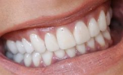 Katie Holmes teeth