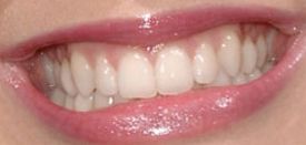 image of Katy Perry's teeth