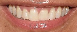 Picture of Kelly Killoren Bensimon teeth and smile
