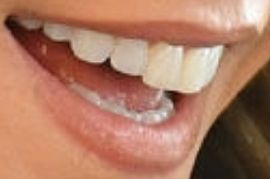 Kelly Ripa's teeth