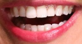 Kelsea Ballerini teeth and smile