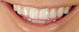 Kelsea Ballerini teeth