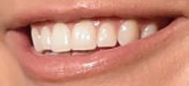 Kelsea Ballerini teeth and smile