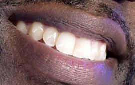 Picture of Kevin Hart teeth and smile