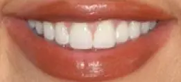 Khloe Kardashian's teeth