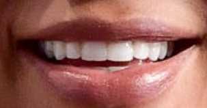 Kim Kardashian's teeth