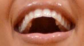 Kim Kardashian's teeth