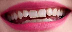 Picture of Kirsten Dunst's teeth while smiling