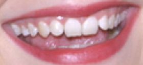 Picture of Kirsten Dunst's teeth while smiling