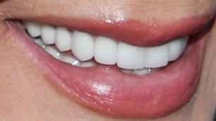 Kris Jenner's teeth