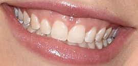 Picture of Kristen Alderson teeth and smile