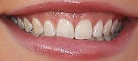 Picture of Kristen Alderson teeth and smile
