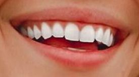 Picture of Krystal Nielson teeth and smile