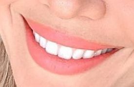 Picture of Krystal Nielson teeth and smile