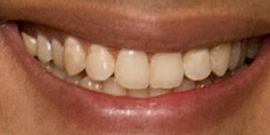 Picture of Kunal Nayyar teeth and smile