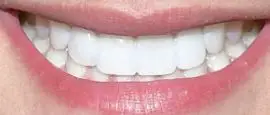 Picture of Laine Hardy teeth and smile
