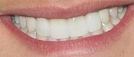 Picture of Laine Hardy teeth and smile