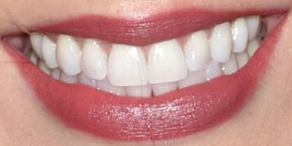 Picture of Laura Osnes teeth and smile