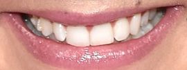 Picture of Lauren Alaina teeth and smile