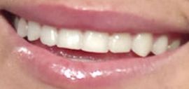 Picture of Lauren Conrad teeth and smile