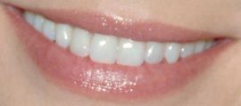 Picture of Lauren German teeth and smile