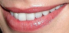 Picture of Lauren German teeth and smile