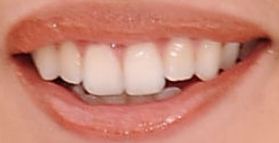 Picture of Lauren Jauregui teeth and smile