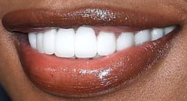 Picture of Laverne Cox teeth and smile