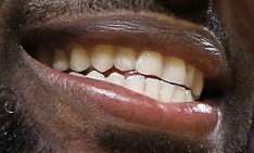LeBron James teeth