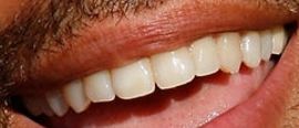 Picture of Lenny Kravitz teeth and smile