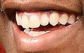 Picture of Lil Durk teeth and smile