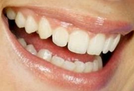Picture of Lily Allen teeth and smile