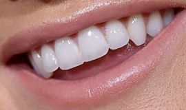 Picture of Lindsay Arnold teeth and smile