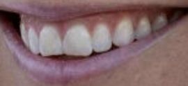 Picture of Lindsey Vonn teeth and smile