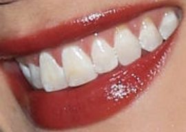 Picture of Linsey Godfrey teeth and smile