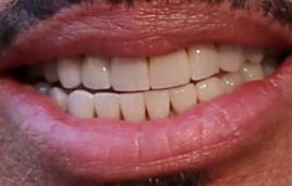 Picture of Lionel Richie teeth and smile