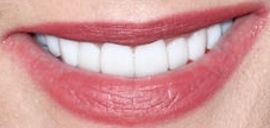 Picture of Lisa Marie Presley teeth and smile