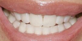 Picture of Lisa Rinna teeth and smile