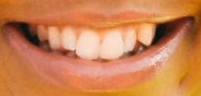 Image of Lizzo's teeth