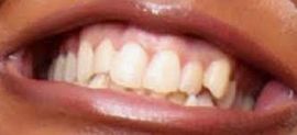 Image of Lizzo's teeth