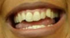 Lizzo's teeth