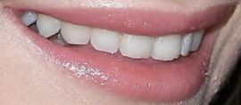 Picture of Lorde teeth and smile
