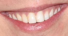 Picture of Lukas Gage teeth and smile