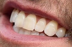 Image of Luke Bryan teeth