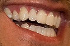 Image of Image of Luke Bryan teeth