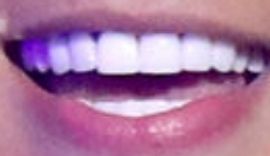 Picture of Lunay teeth and smile