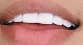 Picture of Lunay teeth and smile