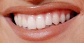 Picture of Mabel teeth and smile