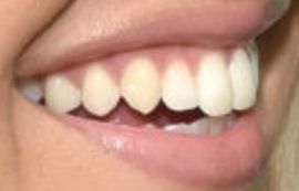Picture of Mabel teeth and smile